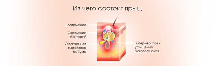 Что делать после выдавливания прыща – пошаговая инструкция Что делать после выдавливания прыща – пошаговая инструкция