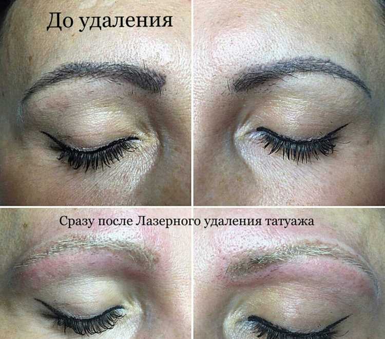 Лазерное удаление перманентного макияжа бровей – преимущества и недостатки