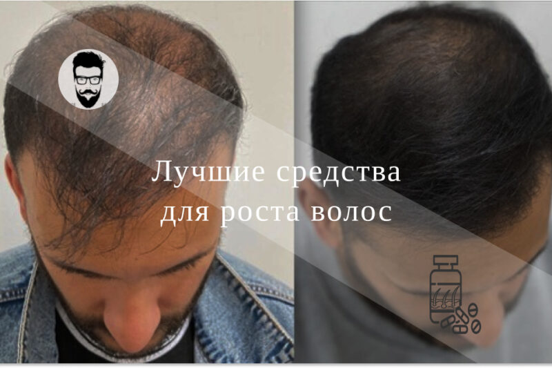 ТОП 7 масел, предотвращающие выпадение волос